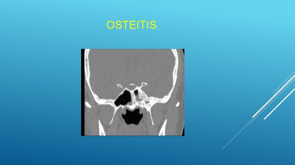 OSTEITIS OSTEITIS