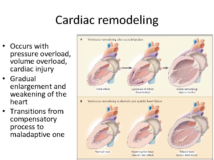 Cardiac remodeling • Occurs with pressure overload, volume overload, cardiac injury • Gradual enlargement