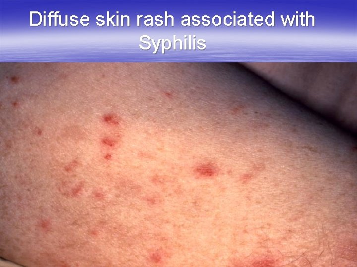 Diffuse skin rash associated with Syphilis 