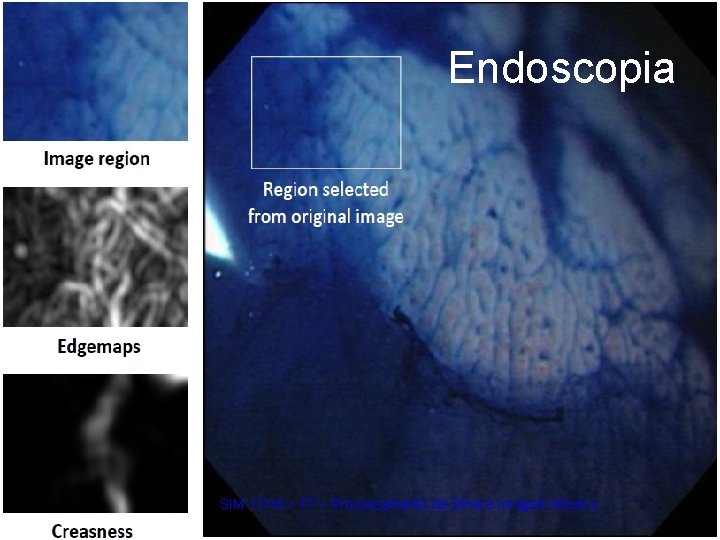 Endoscopia SIM 17/18 – T 7 – Processamento de Sinal e Imagem Médica 