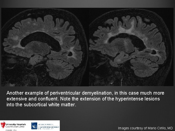 Another example of periventricular demyelination, in this case much more extensive and confluent. Note