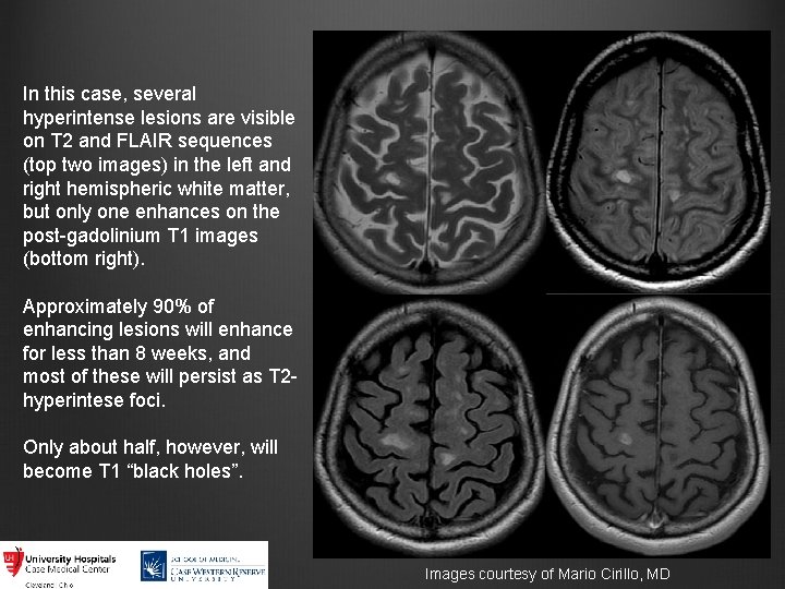 In this case, several hyperintense lesions are visible on T 2 and FLAIR sequences