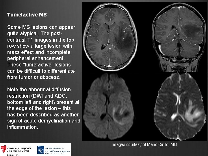 Tumefactive MS Some MS lesions can appear quite atypical. The postcontrast T 1 images