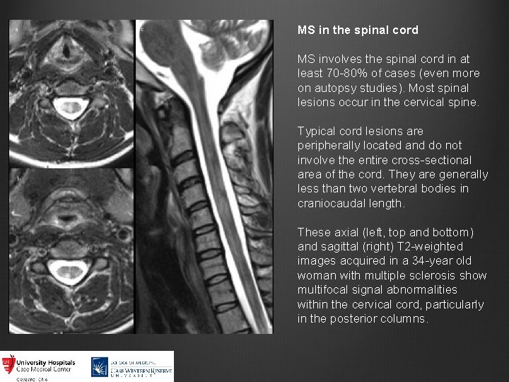 MS in the spinal cord MS involves the spinal cord in at least 70