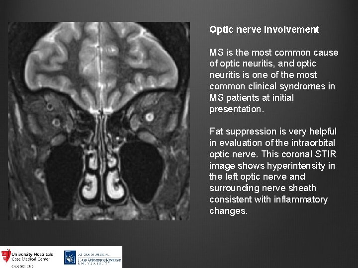 Optic nerve involvement MS is the most common cause of optic neuritis, and optic
