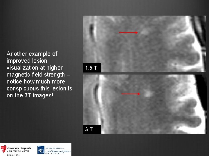 Another example of improved lesion visualization at higher magnetic field strength – notice how