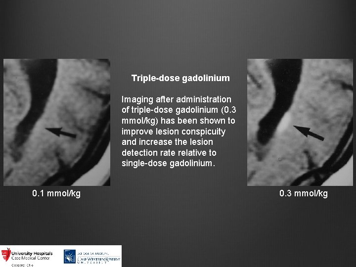 Triple-dose gadolinium Imaging after administration of triple-dose gadolinium (0. 3 mmol/kg) has been shown