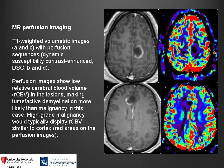 MR perfusion imaging T 1 -weighted volumetric images (a and c) with perfusion sequences