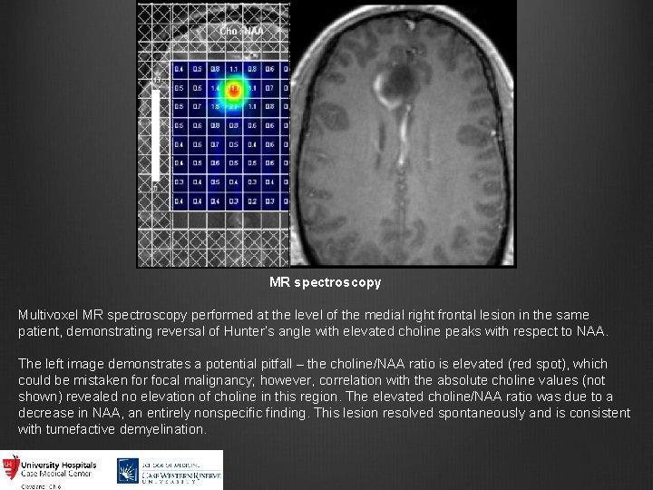 MR spectroscopy Multivoxel MR spectroscopy performed at the level of the medial right frontal