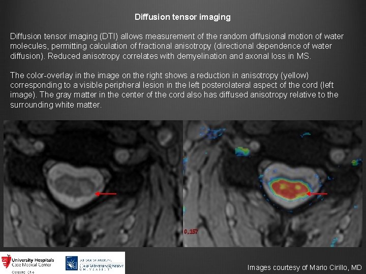 Diffusion tensor imaging (DTI) allows measurement of the random diffusional motion of water molecules,