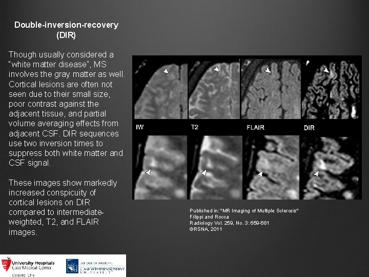 Double-inversion-recovery (DIR) Though usually considered a “white matter disease”, MS involves the gray matter