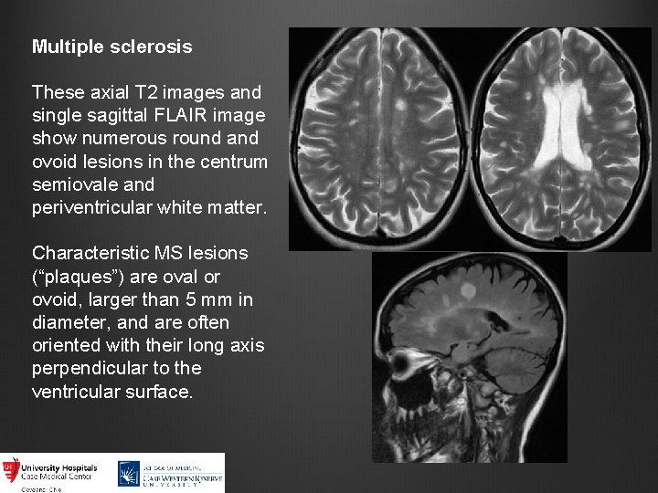 Multiple sclerosis These axial T 2 images and single sagittal FLAIR image show numerous