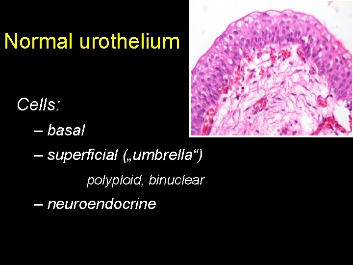 Normal urothelium Cells: – basal – superficial („umbrella“) polyploid, binuclear – neuroendocrine 