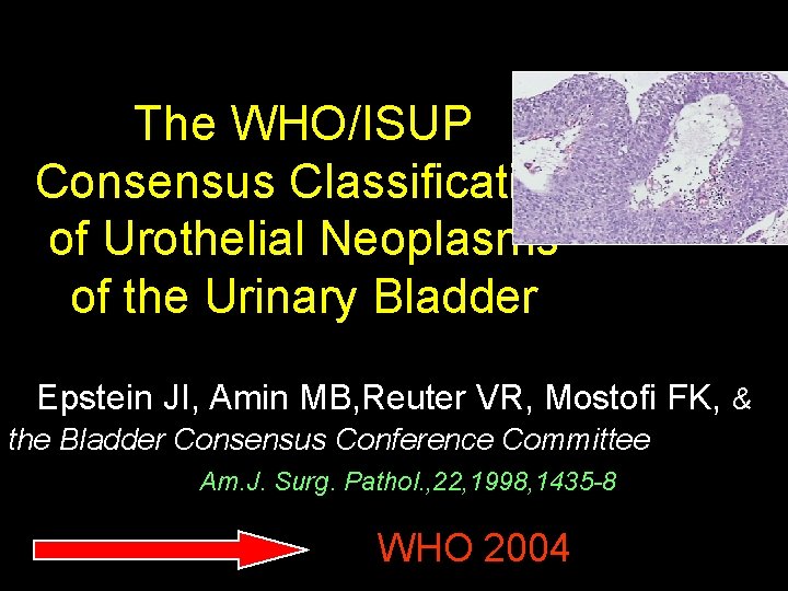 The WHO/ISUP Consensus Classification of Urothelial Neoplasms of the Urinary Bladder Epstein JI, Amin