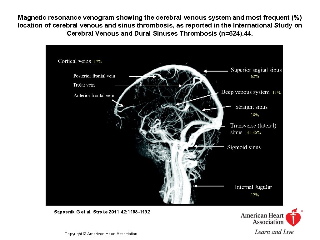 Magnetic resonance venogram showing the cerebral venous system and most frequent (%) location of