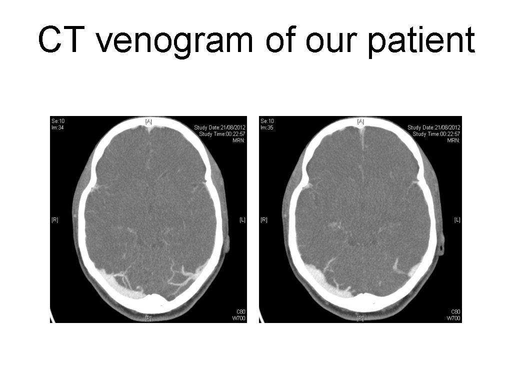 CT venogram of our patient 