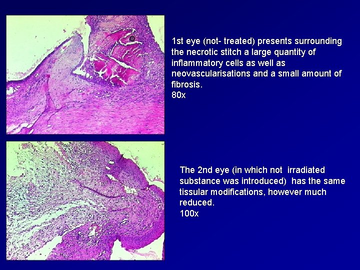 1 st eye (not- treated) presents surrounding the necrotic stitch a large quantity of