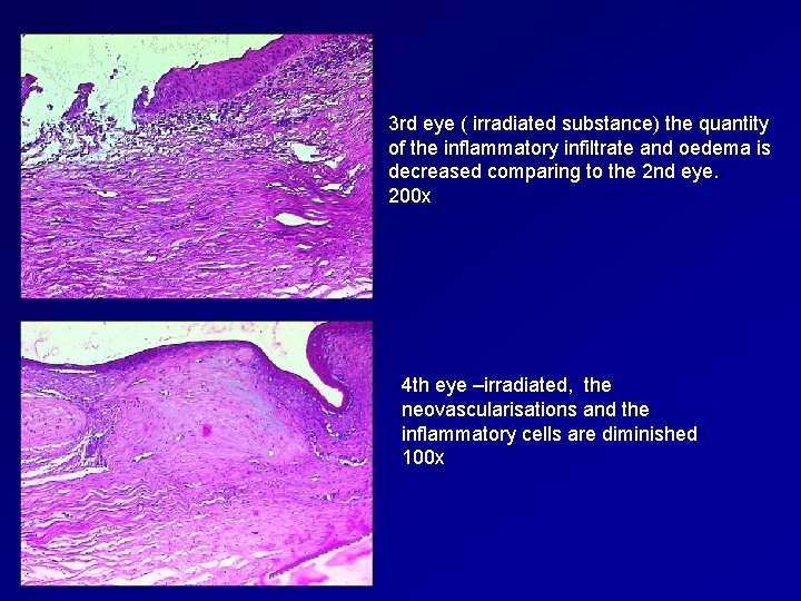 3 rd eye ( irradiated substance) the quantity of the inflammatory infiltrate and oedema