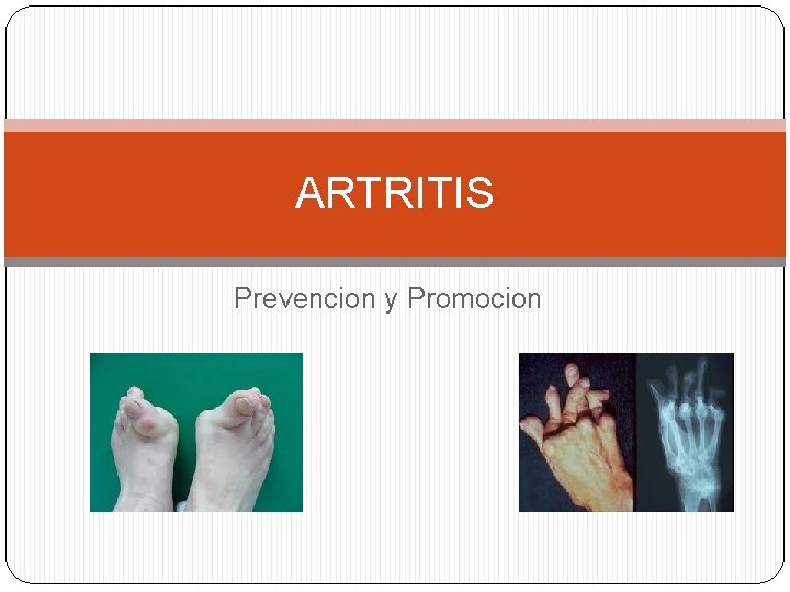 ARTRITIS Prevencion y Promocion 