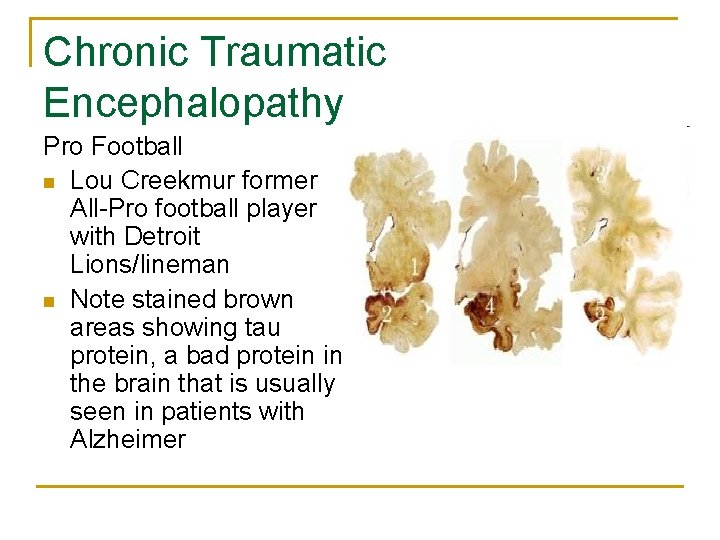 Chronic Traumatic Encephalopathy Pro Football n Lou Creekmur former All-Pro football player with Detroit