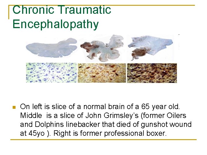 Chronic Traumatic Encephalopathy n On left is slice of a normal brain of a