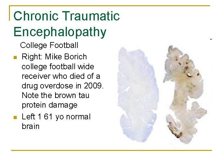 Chronic Traumatic Encephalopathy n n College Football Right: Mike Borich college football wide receiver