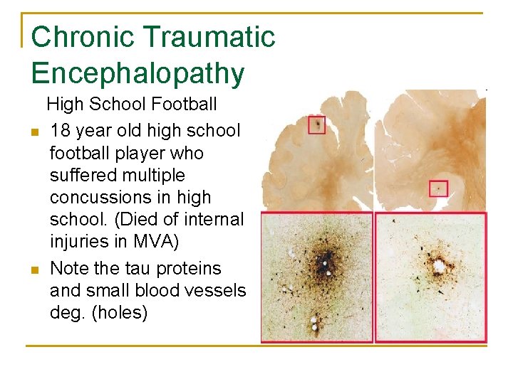 Chronic Traumatic Encephalopathy n n High School Football 18 year old high school football