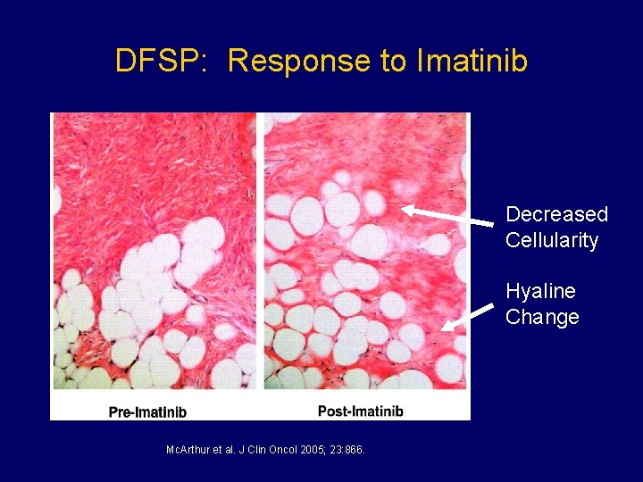 DFSP: Response to Imatinib Decreased Cellularity Hyaline Change Mc. Arthur et al. J Clin