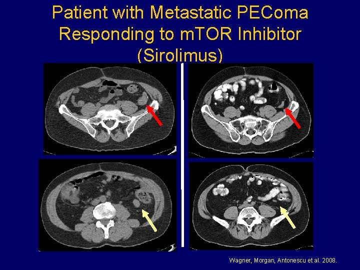 Patient with Metastatic PEComa Responding to m. TOR Inhibitor (Sirolimus) Wagner, Morgan, Antonescu et