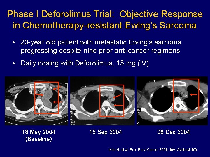 Phase I Deforolimus Trial: Objective Response in Chemotherapy-resistant Ewing’s Sarcoma • 20 -year old