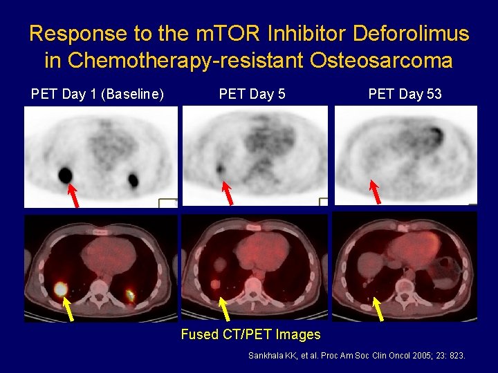 Response to the m. TOR Inhibitor Deforolimus in Chemotherapy-resistant Osteosarcoma PET Day 1 (Baseline)