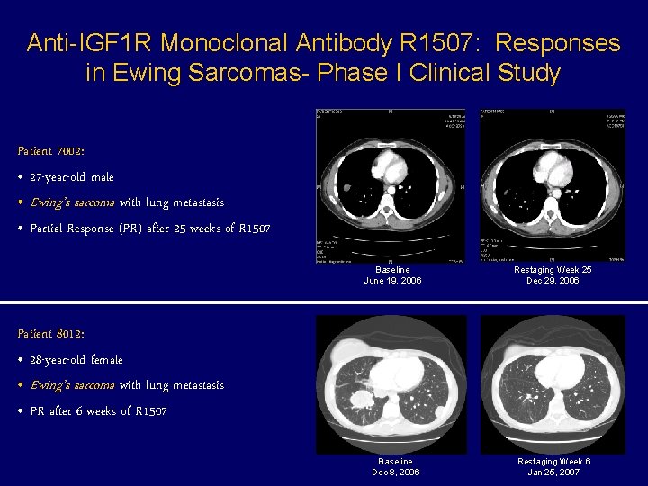 Anti-IGF 1 R Monoclonal Antibody R 1507: Responses in Ewing Sarcomas- Phase I Clinical