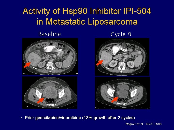 Activity of Hsp 90 Inhibitor IPI-504 in Metastatic Liposarcoma Baseline Cycle 9 • Prior