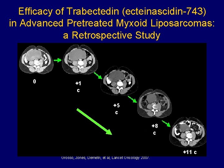 Efficacy of Trabectedin (ecteinascidin-743) in Advanced Pretreated Myxoid Liposarcomas: a Retrospective Study 0 +1