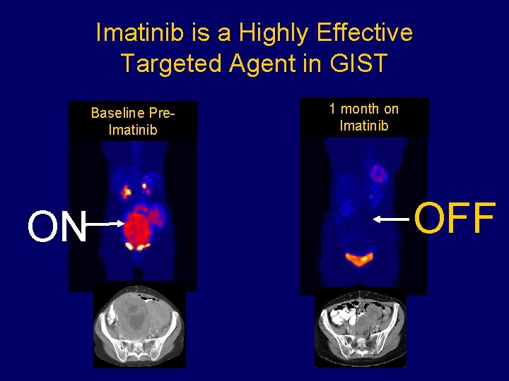 Imatinib is a Highly Effective Targeted Agent in GIST Baseline Pre. Imatinib ON 1