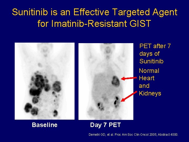 Sunitinib is an Effective Targeted Agent for Imatinib-Resistant GIST PET after 7 days of