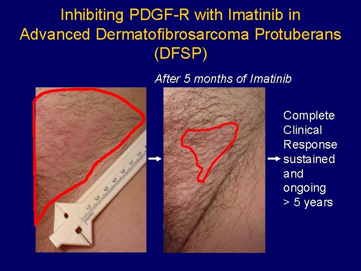 Inhibiting PDGF-R with Imatinib in Advanced Dermatofibrosarcoma Protuberans (DFSP) After 5 months of Imatinib