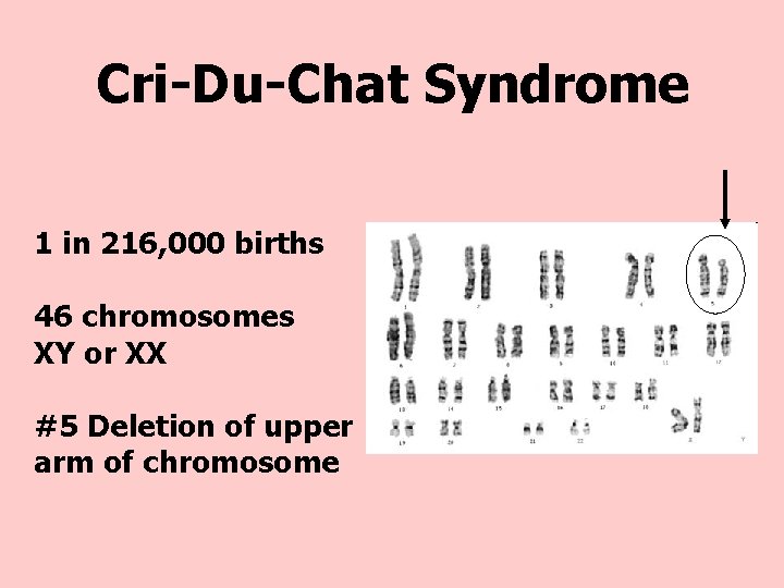 Cri-Du-Chat Syndrome 1 in 216, 000 births 46 chromosomes XY or XX #5 Deletion