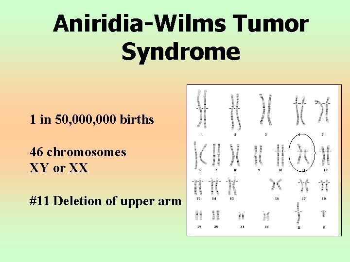 Aniridia-Wilms Tumor Syndrome 1 in 50, 000 births 46 chromosomes XY or XX #11