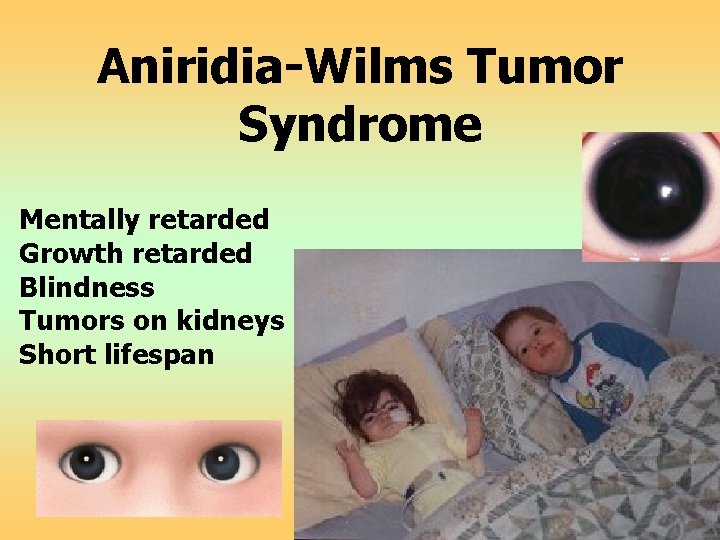 Aniridia-Wilms Tumor Syndrome Mentally retarded Growth retarded Blindness Tumors on kidneys Short lifespan 