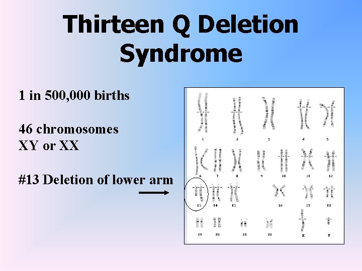 Thirteen Q Deletion Syndrome 1 in 500, 000 births 46 chromosomes XY or XX
