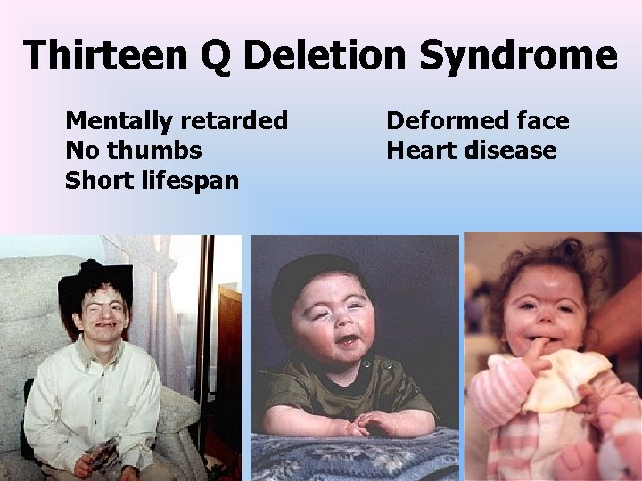 Thirteen Q Deletion Syndrome Mentally retarded No thumbs Short lifespan Deformed face Heart disease