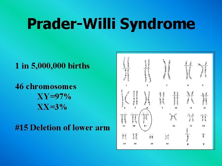 Prader-Willi Syndrome 1 in 5, 000 births 46 chromosomes XY=97% XX=3% #15 Deletion of