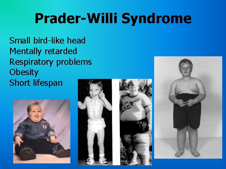 Prader-Willi Syndrome Small bird-like head Mentally retarded Respiratory problems Obesity Short lifespan 