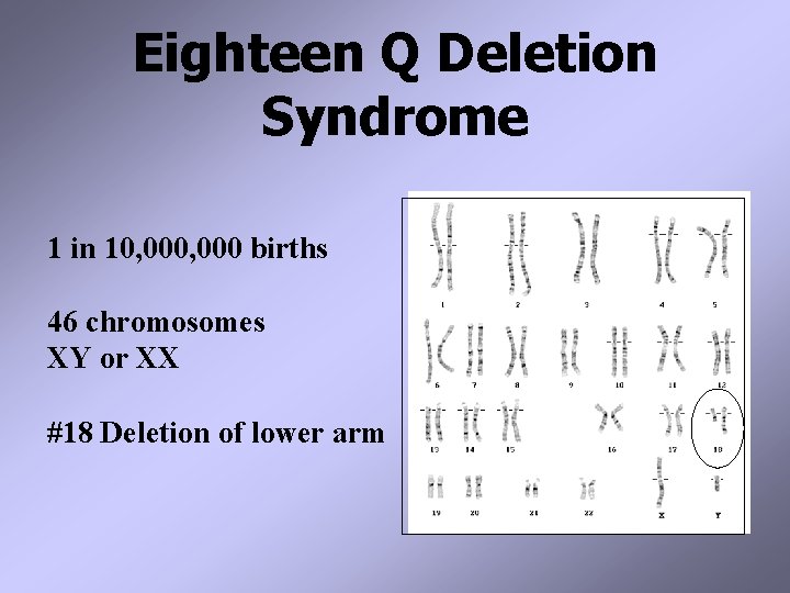 Eighteen Q Deletion Syndrome 1 in 10, 000 births 46 chromosomes XY or XX