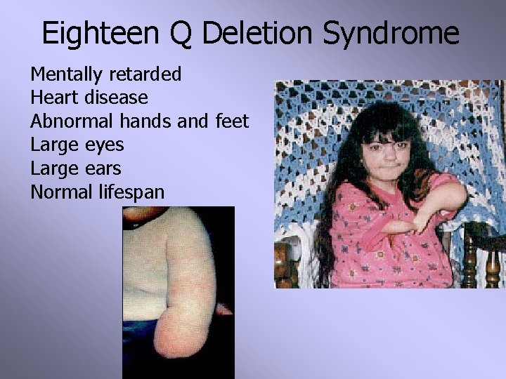 Eighteen Q Deletion Syndrome Mentally retarded Heart disease Abnormal hands and feet Large eyes