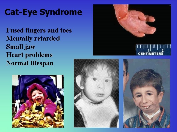 Cat-Eye Syndrome Fused fingers and toes Mentally retarded Small jaw Heart problems Normal lifespan