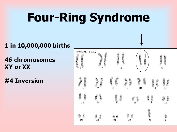 Four-Ring Syndrome 1 in 10, 000 births 46 chromosomes XY or XX #4 Inversion