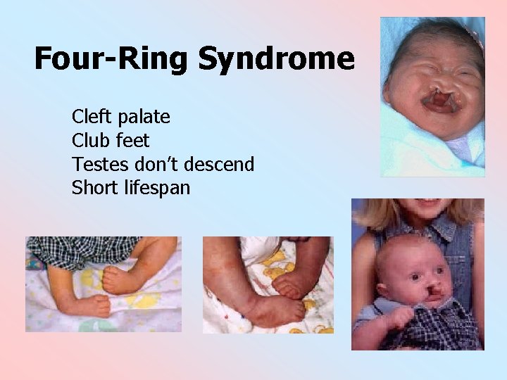 Four-Ring Syndrome Cleft palate Club feet Testes don’t descend Short lifespan 