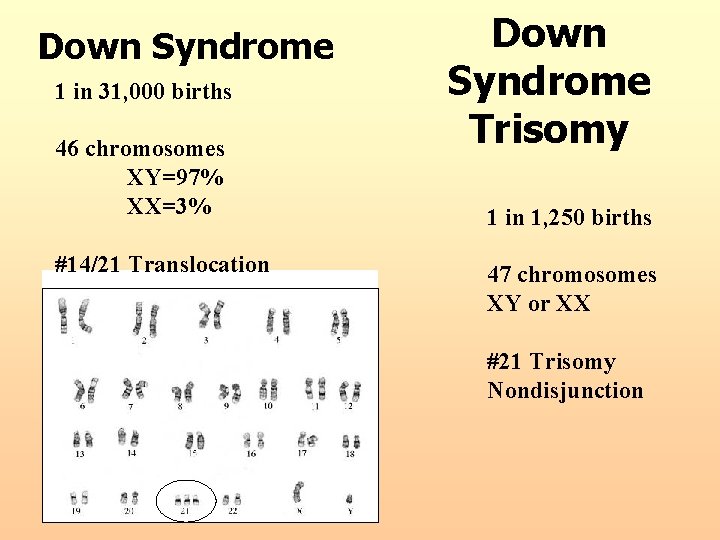 Down Syndrome 1 in 31, 000 births 46 chromosomes XY=97% XX=3% #14/21 Translocation Down